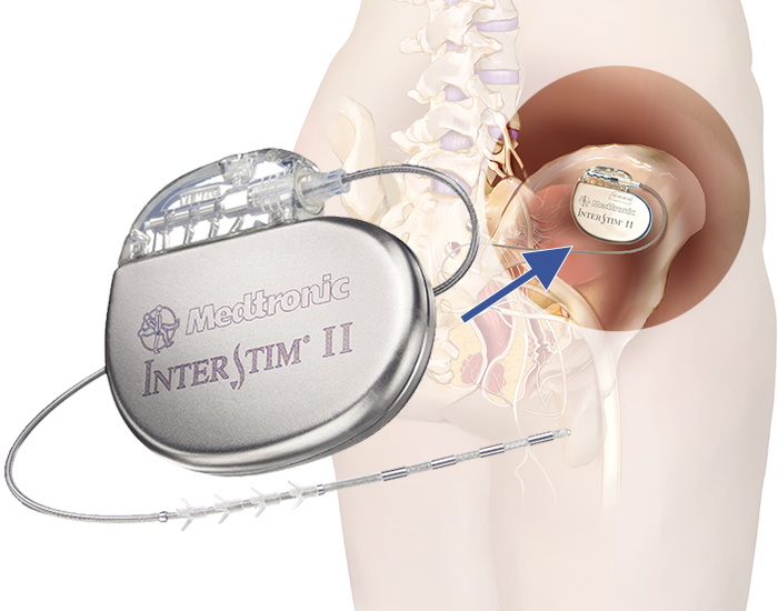 Sacral Neuromodulation (Interstim® Therapy) Star Clinic